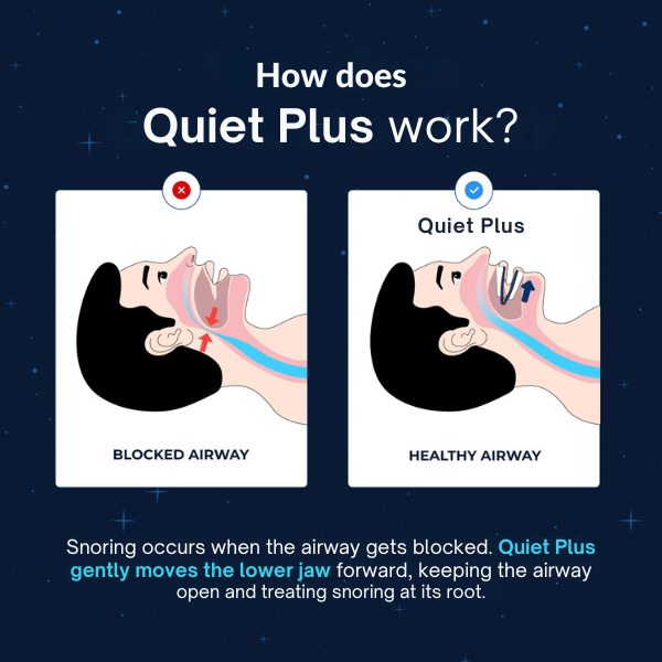 Quiet Plus Adjustable Anti-Snoring Mouthpiece